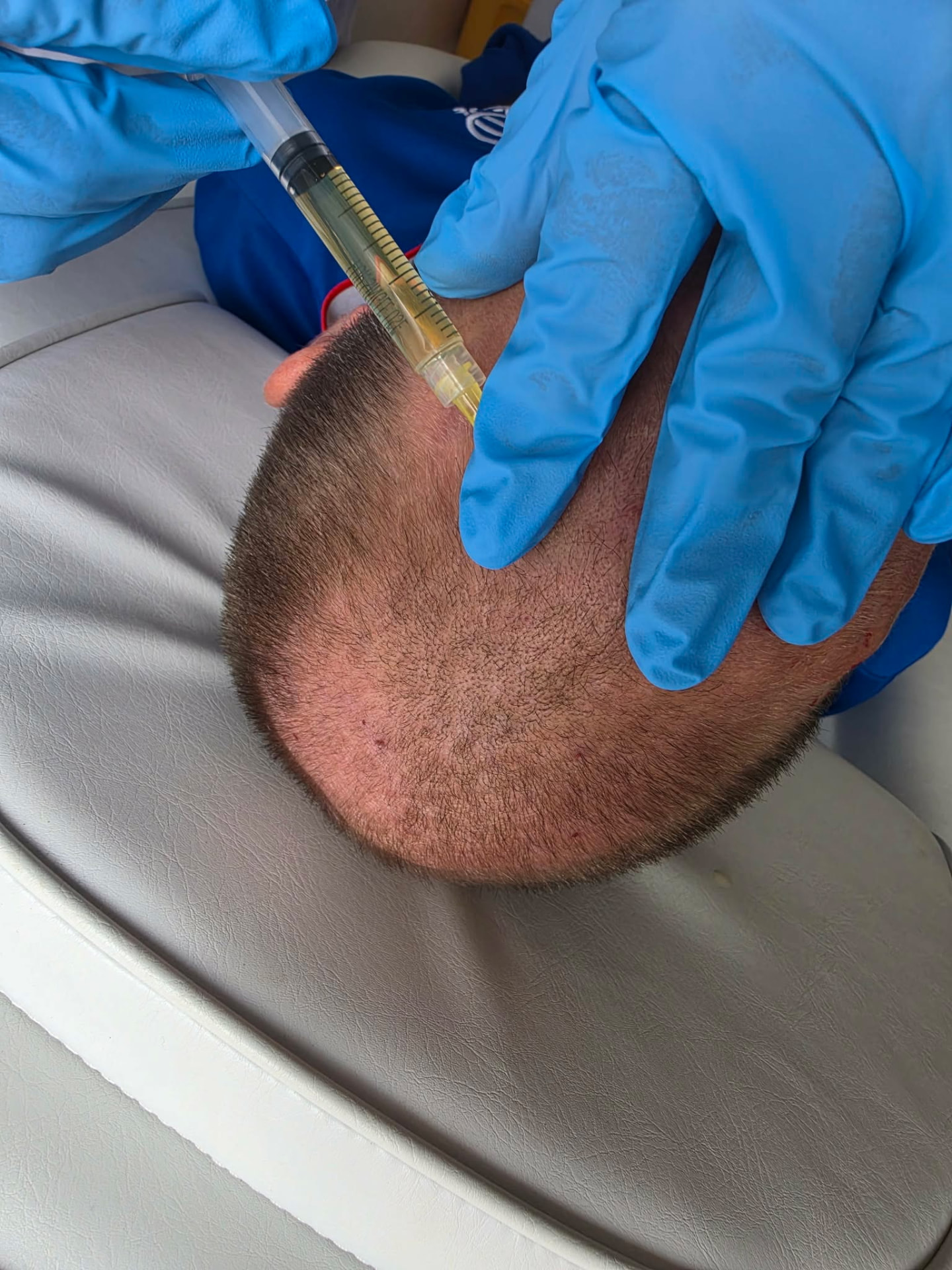 Prepared plasma being applied to the scalp during a PRP appointment